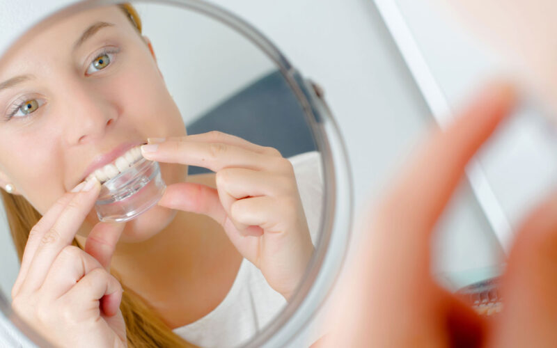 Calgary Mouth Guards | White Oak Dental Clinic | Calgary AB