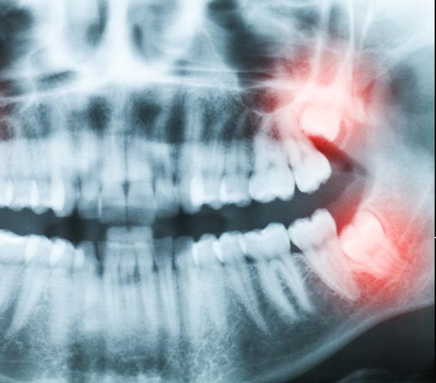 -understanding-impacted-wisdom-teeth-wisdom-teeth-extraction-white-oak-dental-general-dental-clinic-se-calgary