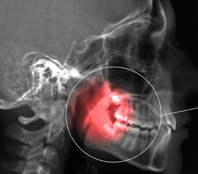 what-to-expect-during-a-wisdom-teeth-evaluation-wisdom-teeth-extraction-white-oak-dental-general-dental-clinic-se-calgary