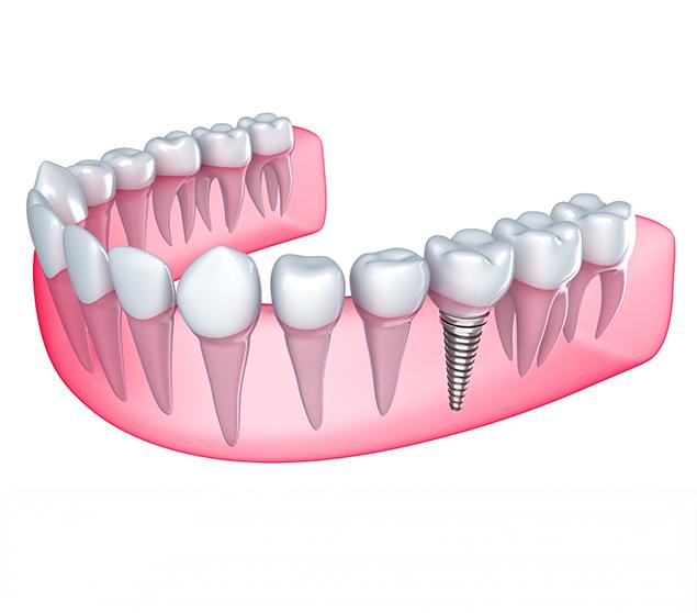 What to Expect With Implant Treatment | White Oak Dental | General Dentistry | SE Calgary