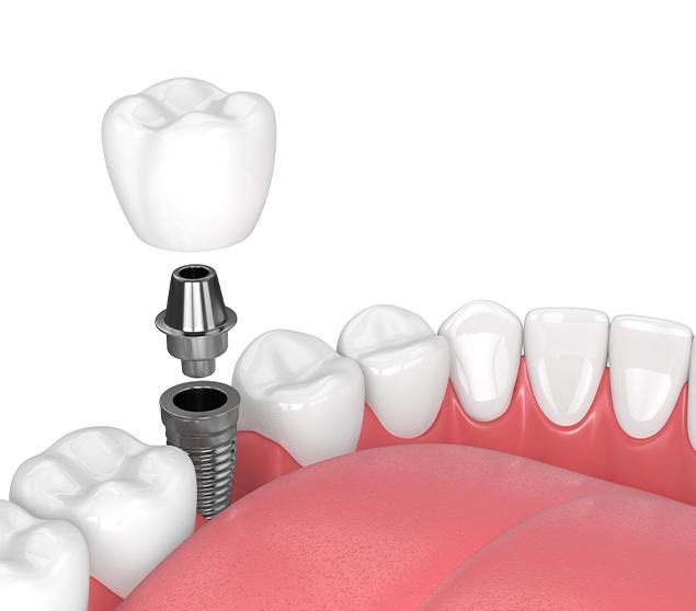 What to Expect With Implant Treatment | White Oak Dental | General Dentistry | SE Calgary